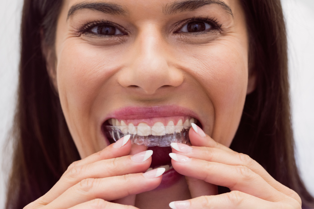 İnvisalign