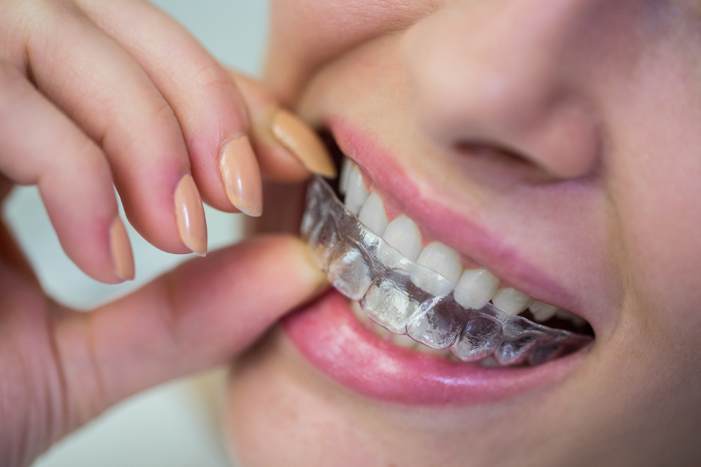 Şeffaf Plak Tedavisi-İnvisalign